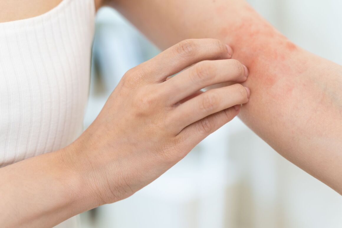 Allergische Reaktion der Haut